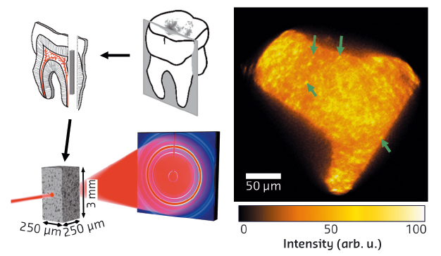 Slices cut from human teeth were used to create small pin-like bars which were mounted for diffraction-tomography