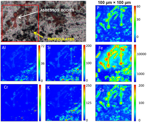 μXRF analyses of asbestos bodies and particulates in human lung tissue.